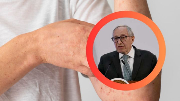 Sarampión se propaga en 17 estados; activan plan urgente de vacunación y control del dengue