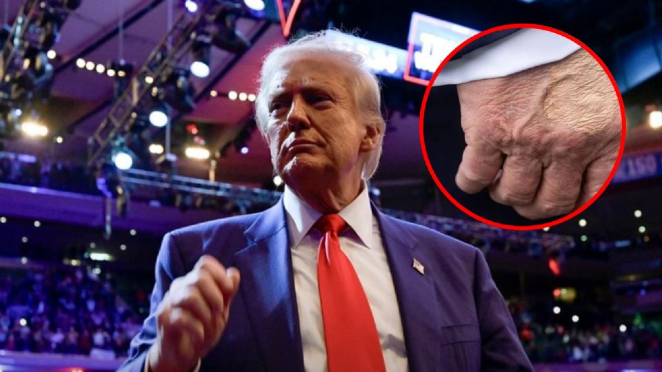 Diagnostican a Trump con importante enfermedad