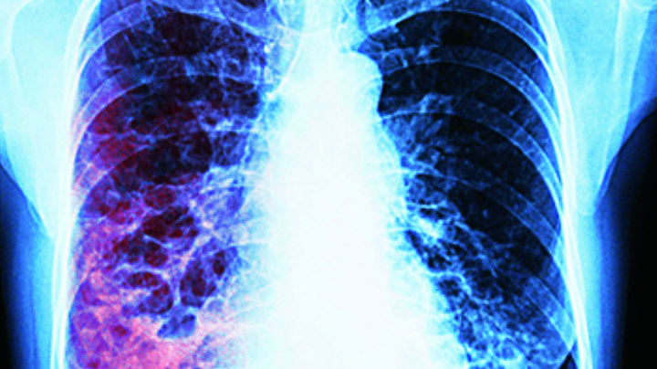 Mueren 12 a causa de la tuberculosis en Nuevo Laredo