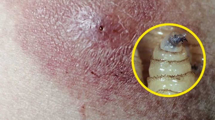 Gusano barrenador en México: hombre llega infectado al hospital, ¿cómo se contagió?