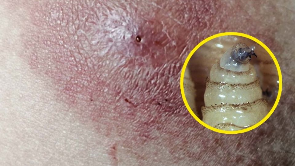 El gusano barrenador presente en humanos