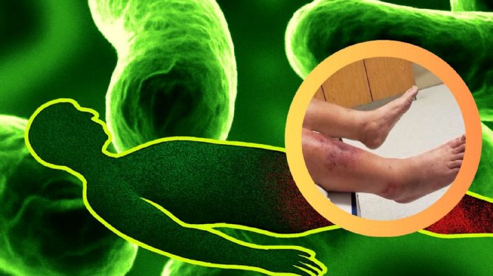 Emiten alerta por 'bacteria devoradora de carne'; ya hay 89 muertos