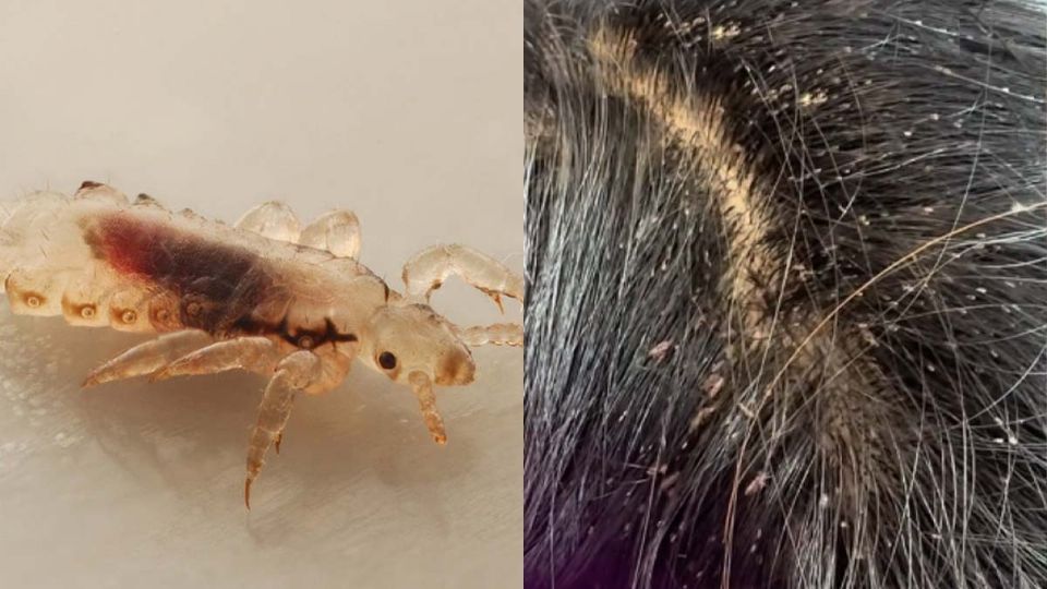 Los niños se contagian fácilmente de piojos
