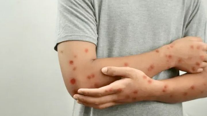 Alerta sanitaria: regresa la viruela del mono a México; detectan nuevo caso en este estado