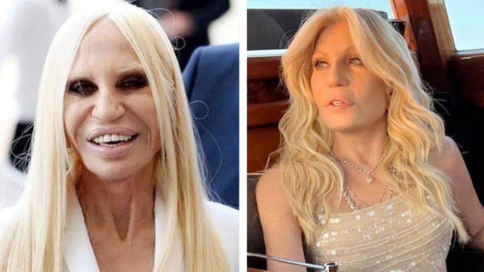 Donatella y sus procedimientos faciales