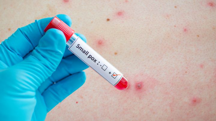 Confirman primer caso de Viruela Símica en México; paciente extranjero es detectado en Acapulco