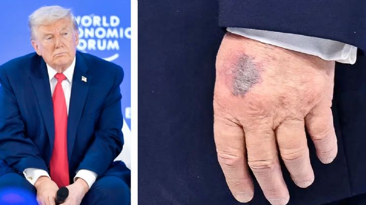 ¿Qué le pasó a Donald Trump?, extraños ‘moretones’ en sus manos desatan teorías sobre su salud