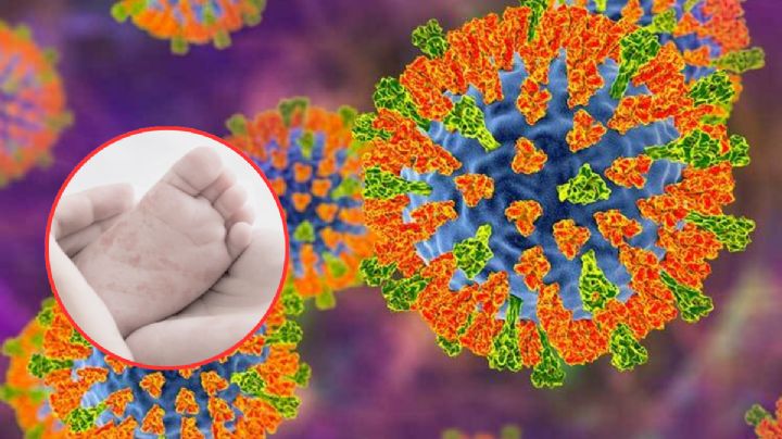 Confirman la muerte de un bebé en Tlaxcala por sarampión; tenía esquema de vacunación incompleto