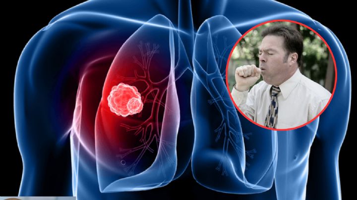 Cáncer de pulmón: las señales silenciosas que aparecen antes de lo que imaginas