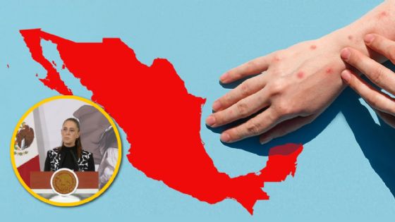 ¿De dónde vino el sarampión en México?; Secretaría de Salud confirma origen importado desde EU