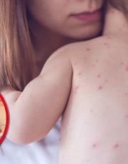 Foto descriptiva de: ¿Tuviste sarampión de niño?; las pruebas médicas que revelan si tienes inmunidad