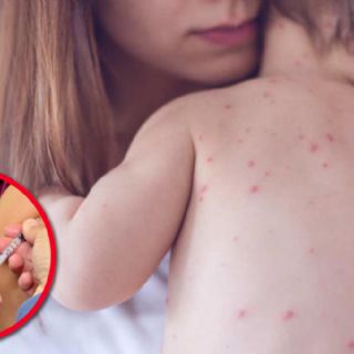 ¿Tuviste sarampión de niño?; las pruebas médicas que revelan si tienes inmunidad