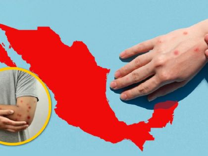 Sarampión en México: más de 9 mil casos confirmados invaden al país