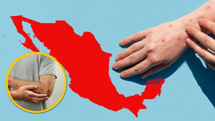 Alerta por sarampión en México; reportan miles de contagios y 29 defunciones