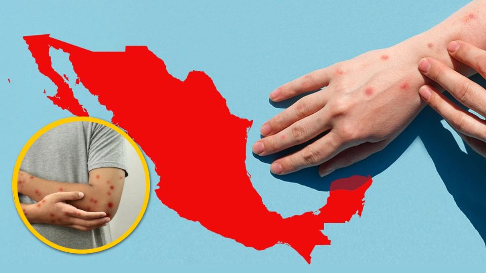 El Sarampión se expanden rápidamente por el territorio mexicano, y la vacunación es más que obligada en estos tiempos