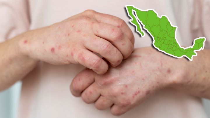 ¿Cuáles son los estados con más casos de sarampión?; autoridades responden