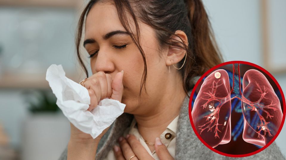 Autoridades reportan 54 casos de tuberculosis en Nuevo Laredo