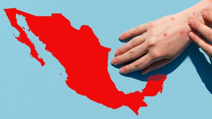 Sarampión retrocede en México; autoridades destacan impacto de 17.2 millones de vacunas aplicadas